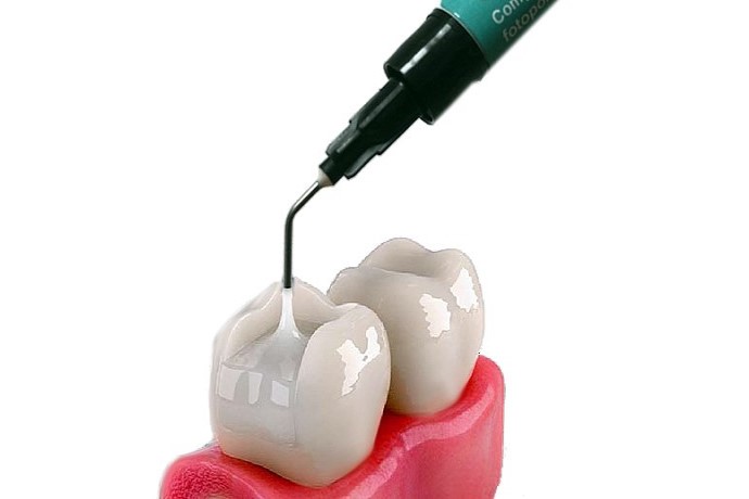 کامپوزیت مایع دندانپزشکی
